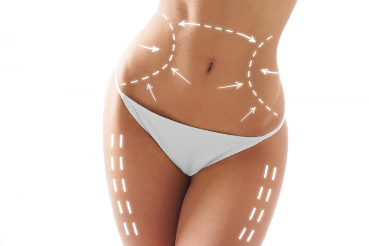 Cryolipolysis